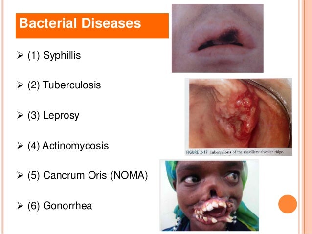 Facial bacterial infections Las vegas hide and seek swinger club